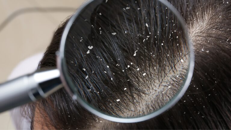 Want a healthy flake-free scalp?